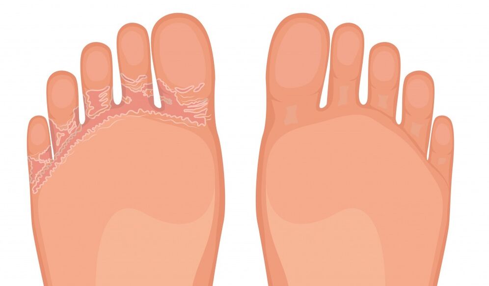 Fungent is effective against all types of foot fungus