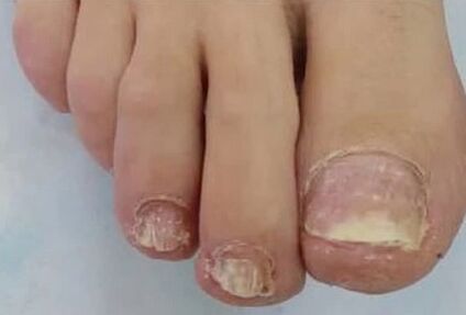 The nails were severely affected by the fungus