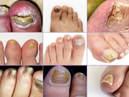 Nail damage for various types of fungi