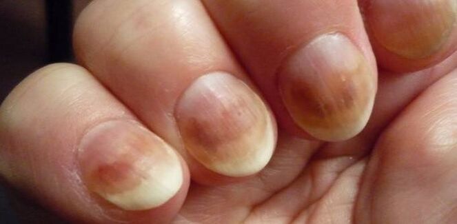 Nail mycosis infection