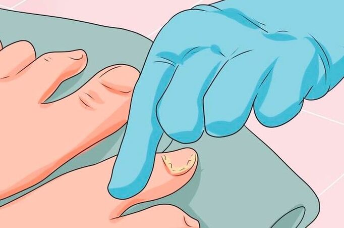 The first signs of nail ringworm