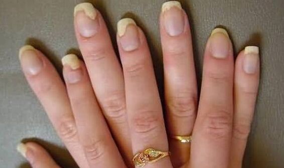 This is how the nail fungus looks like the stage of exacerbation