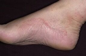 The damage of fungi in the foot
