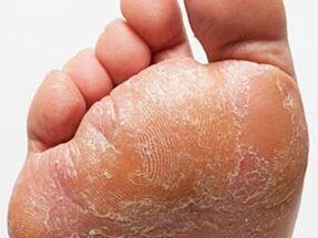 The fungus of the foot