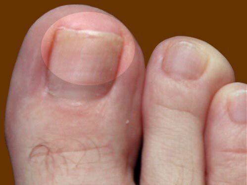 The fungus injury