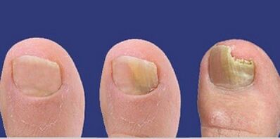Nail fungus development stages